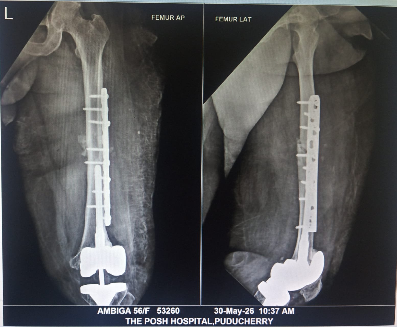Periprosthetic Femur Fracture Case